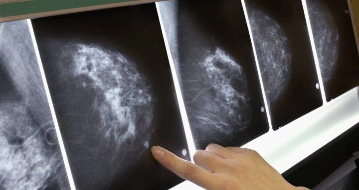 Medicamento logra erradicar el cáncer de ovario en seis días