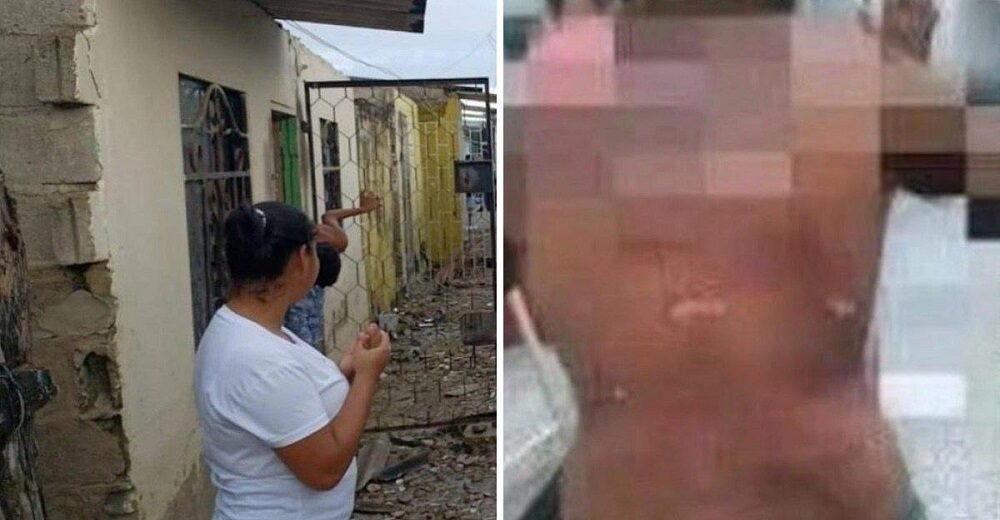 Suegra le quemó la espalda a su yerno con agua hirviendo