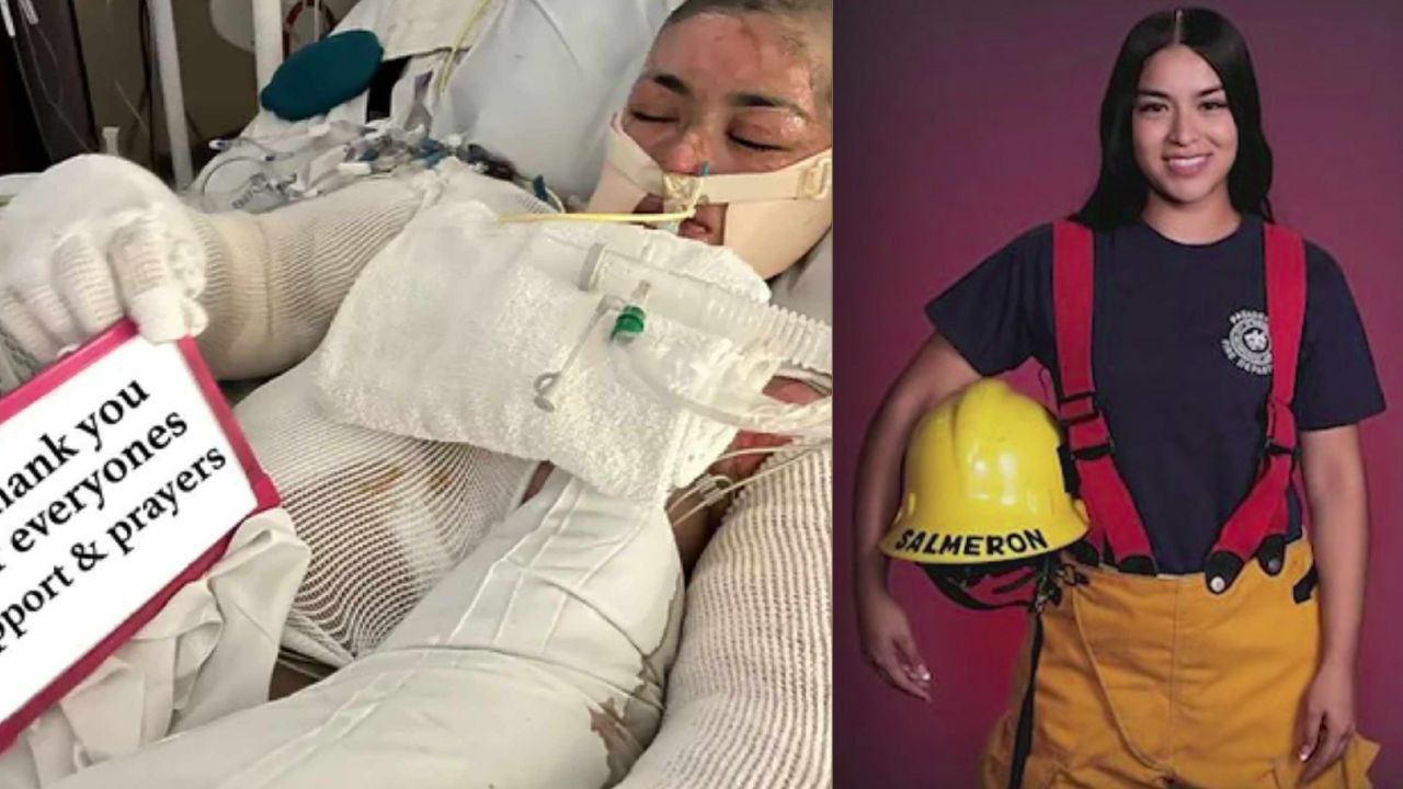 Jovencita aspirante a bombera se quema el 50% de su cuerpo en un trágico accidente