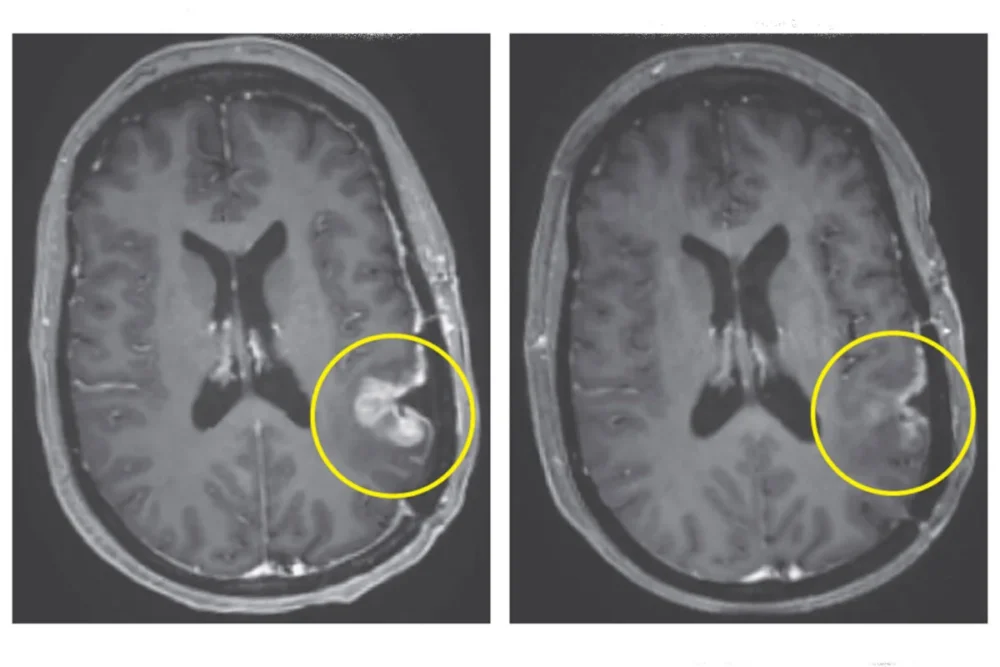 Terapia experimental redujo el cáncer cerebral de tres pacientes drásticamente