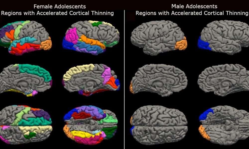 cerebro covid niñas